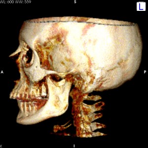 katm1